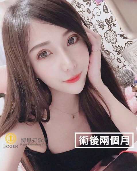 雙眼皮重修與提眼瞼肌矯正手術,提眼瞼肌矯正,博恩妍